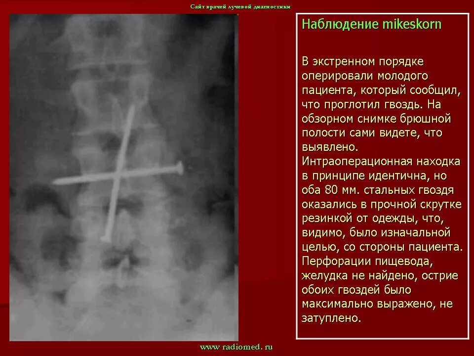 Инородное тело органов брюшной полости рентген. Инородные тела сосудов. Инородные тела при операции. Инородные тела пищеварительного тракта рентген. Инородные тела сосудов.