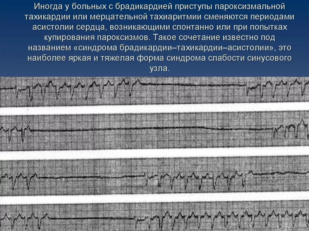 Пароксизмальная тахикардия мерцательная аритмия. Пароксизмальная синусовая брадикардия. желудочковая брадикардия на экг. мерцательная тахиаритмия. пароксизмальная предсердная брадикардия.