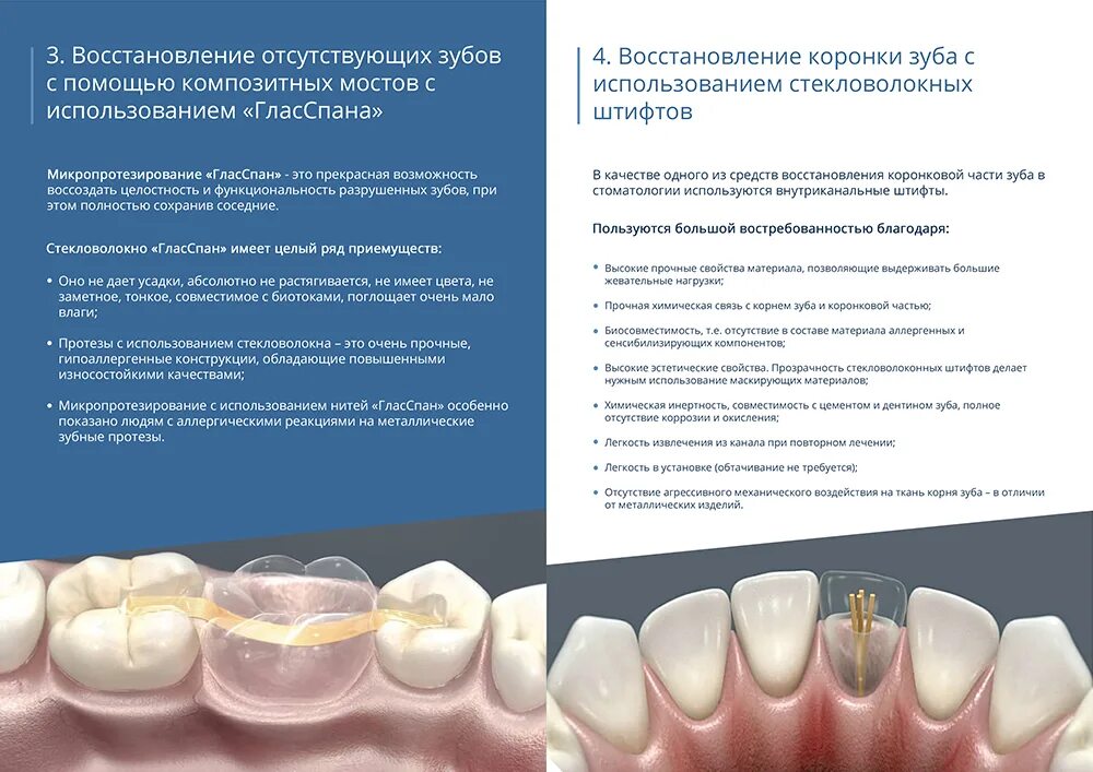Материал для реставрации зубов. Шинирование зубов Glasspan. Микропротезирование зубов стекловолокном. Микропротезирование отсутствующего зуба. Восстановление зуба на ленте Гласспан.