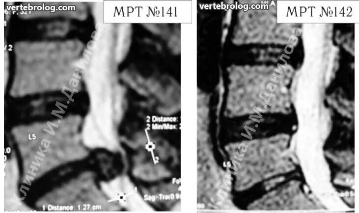 Поясничный абсолютный стеноз. Грыжа диска l5-s1. Межпозвонковые диски l5-s1. Межпозвонковый диск l5-s1.