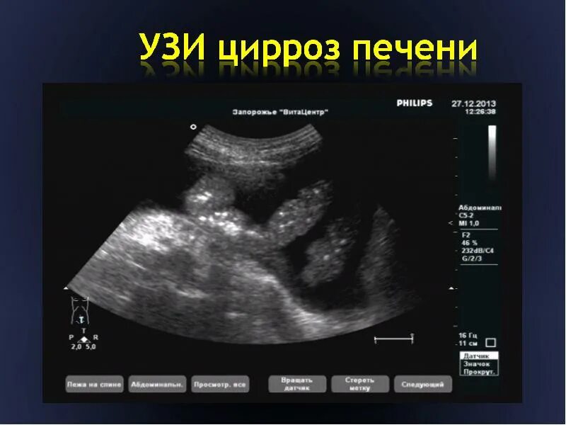 Гепатит желчный пузырь. Ультразвуковое исследование при патологии печени. Снимок УЗИ печени здоровой.