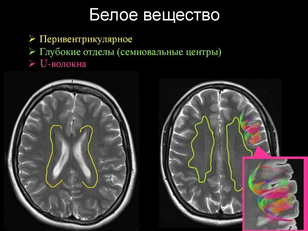 Белые очаги в мозге. Семиовальные центры мрт. Базальные ядра на кт. Базальные ядра головного мозга на кт. Семиовальный центр головного мозга.