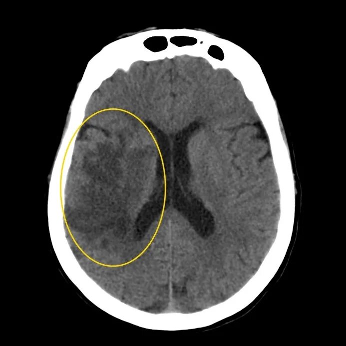 Очаг ишемии мозга. Ишемический инсульт на кт головного мозга. Ишемический инсульт кт картина. Ишемический инсульт снимок кт. Полушарный ишемический инсульт кт.