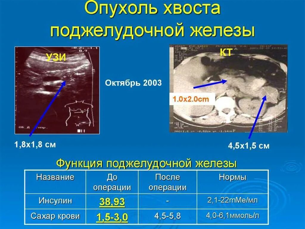 Симптомы рака поджелудочной у мужчин признаки. Опухоль головки поджелудочной железы клиника. Объемное образование тела поджелудочной железы. Опухоль тела и хвоста поджелудочной железы. Образование хвоста поджелудочной железы на УЗИ.