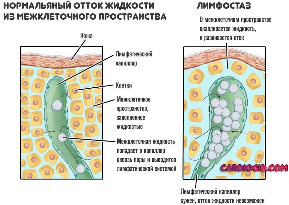 Лимфа и межклеточная жидкость. Отеки в межклеточном пространстве. Механизм развития лимфатического отека. Отеки застой лимфы