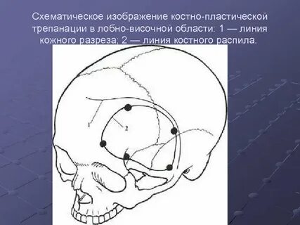 Костно пластическая трепанация