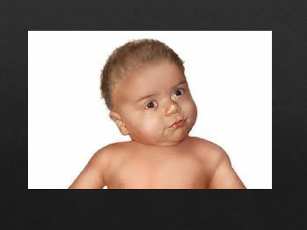 поворот головы новорожденного. кривошея александр. дерматогенная кривошея. деформация черепа у новорожденных. врожденная мышечная кривошея у новорожденных.