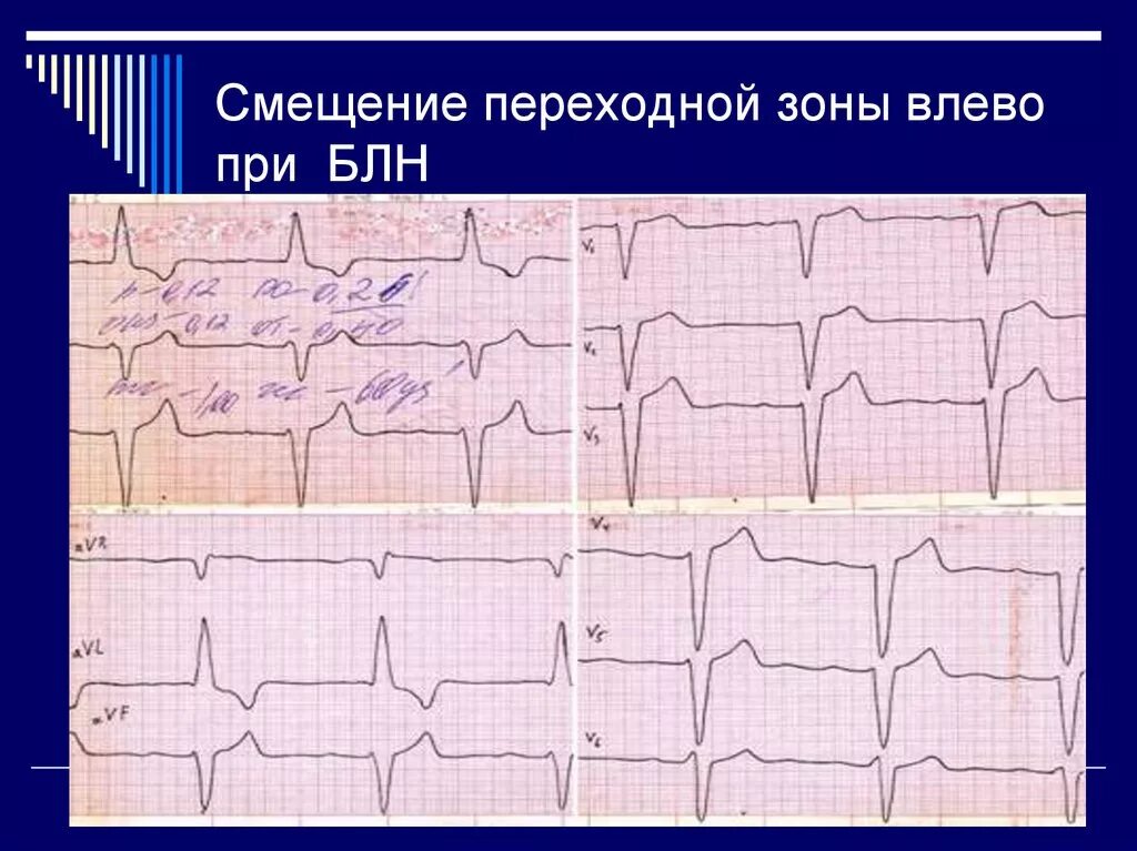Сдвиг переходной зоны вправо. Смещение переходной зоны на экг. переходная зона v1-v2 на экг. переходная зона смещена вправо на экг. экг переходная зона смещение влево.