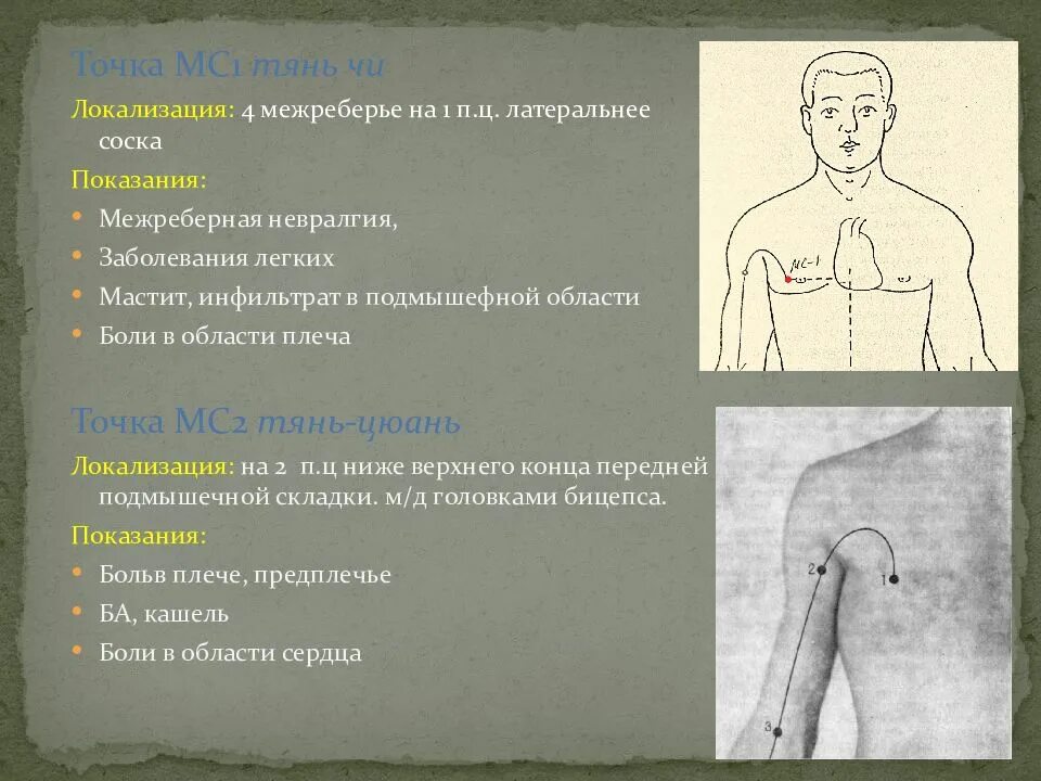 Межреберная блокада. Межреберная невралгия точки. Точки при невралгии. Точечный массаж при межреберной невралгии. Точки при межреберной невралгии.