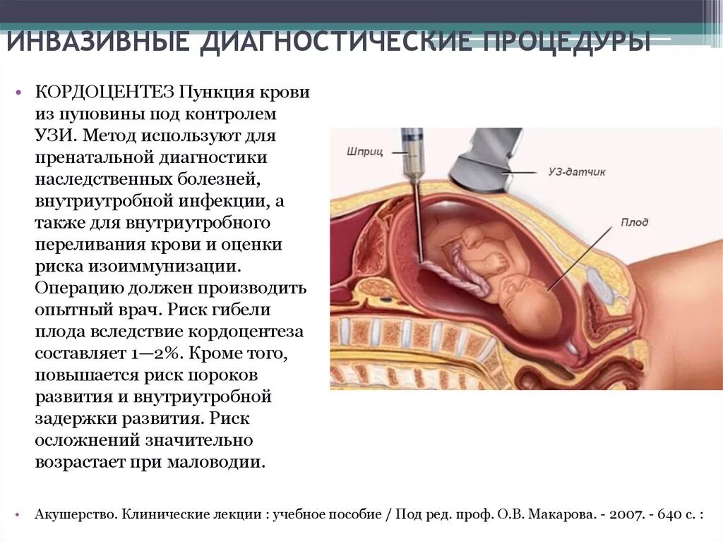 Метод инвазивный кордоцентез. Инвазивный метод пренатальной диагностики. Пренатальная диагностика кордоцентез. Кордоцентез риск осложнений