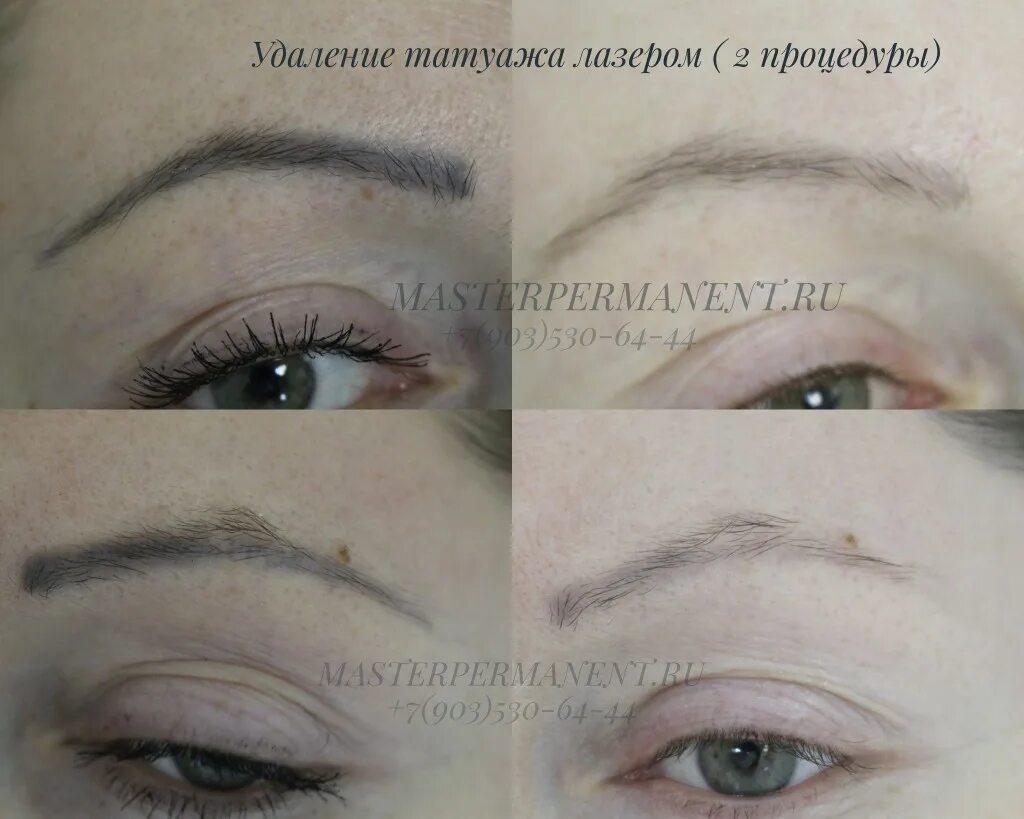 Удаление татуажа видео. Лазерное удаление татуажа. Выведение татуажа лазером. Удаление пм лазером. Сведение татуажа бровей лазером.