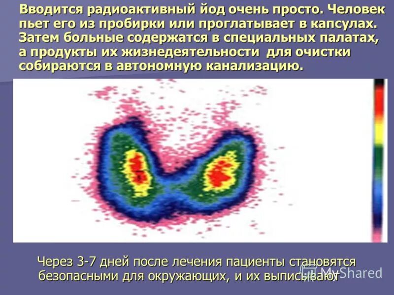 Радиоактивный йод щитовидная