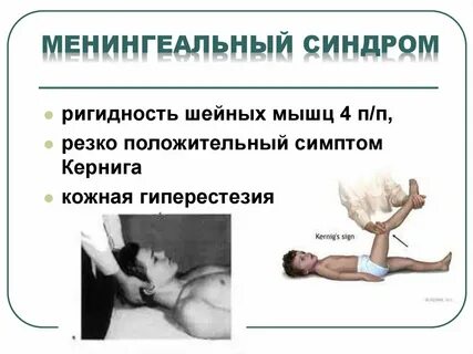 Мышечная ригидность что это