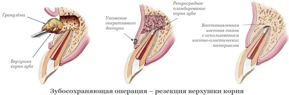 Ретроградный корень. Материалы для ретроградного пломбирования корневого канала. Операция цистэктомия с резекцией верхушки корня. Ретроградное пломбирование верхушки корня. Ретроградная пломбировка канала.
