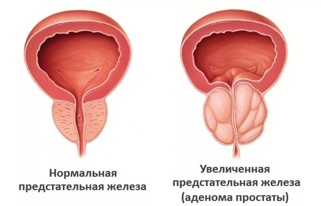 Простата аденома предстательной железы. Аденома предстательной железы. Предстательная железа аденома простаты. Аденома предстательная железа у мужчин.