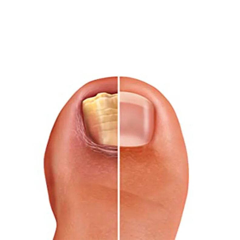 Подноктевой анихалилиз. Онихолизис и онихомикоз. Микотическая лейконихия. Гипертрофический онихомикоз. Как избавиться от ногтя.