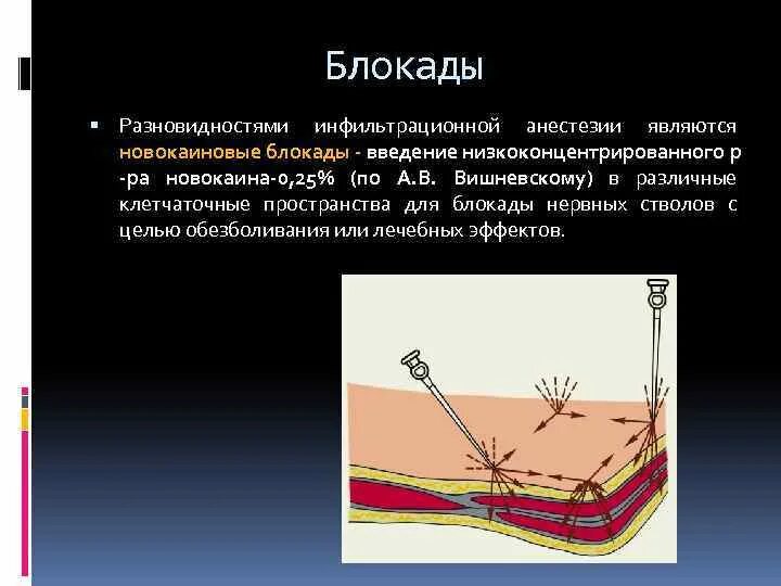 Обезболивающая блокада. Блокады в анестезиологии. Инфильтрационная блокада.