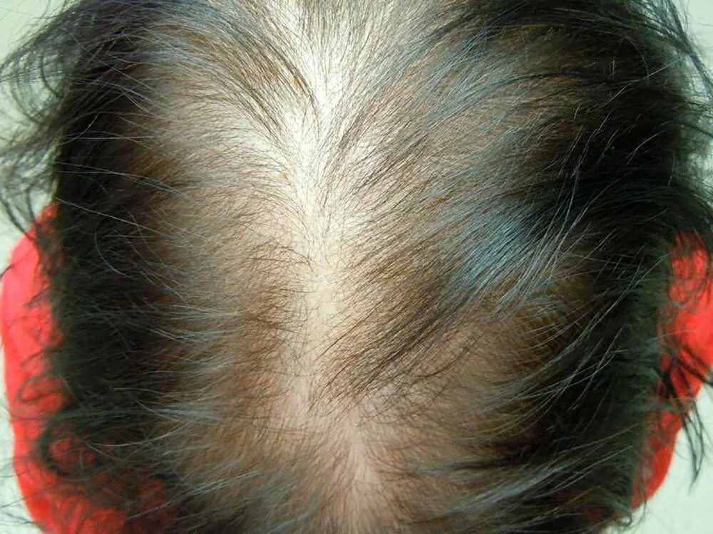 женское облысение