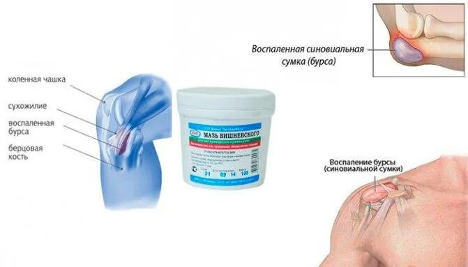 народное средство от коленного сустава. ретропателлярный бурсит. бурсит коленного сустава компрессы. компресс при бурсите для коленного. холодный компресс на колено.