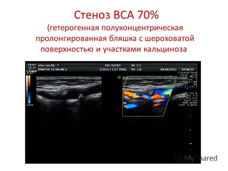 Стенозирующий атеросклероз бца что это. Атеросклероз сонных артерий узи. стеноз сонной артерии 70% узи. узи стеноз вса спектр. стеноз внутренней сонной артерии уздг.