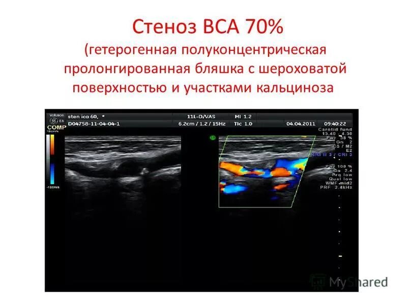 Стеноз устья вса. Атеросклероз сонных артерий УЗИ. Стеноз сонной артерии 70% УЗИ. УЗИ стеноз ВСА спектр. Стеноз внутренней сонной артерии УЗДГ.