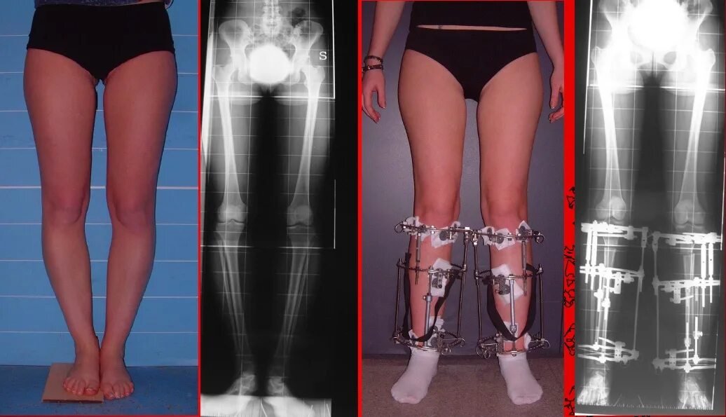 Деформация коленного сустава у детей. Аппарат Илизарова вальгусная. Варусная деформация коленных суставов. Вальгуснаяеформация коленных суставов. Ваоуснея деформаяи колен.