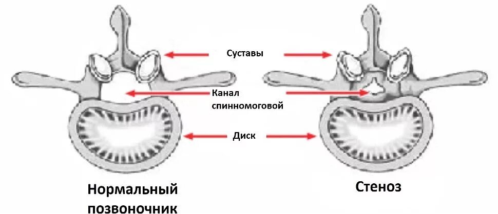 Поясничный абсолютный стеноз