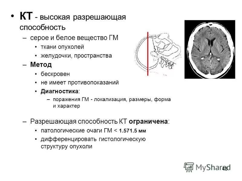 Опухоли желудочков