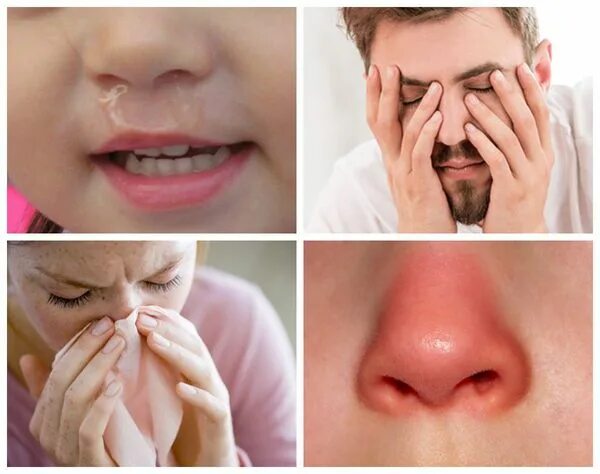 Нос заболевание насморк. Атрофический ринит риноскопия. Хронический катаральный ринит. Воспаление слизистых оболочек носа. Раздражение на слизистых носа.