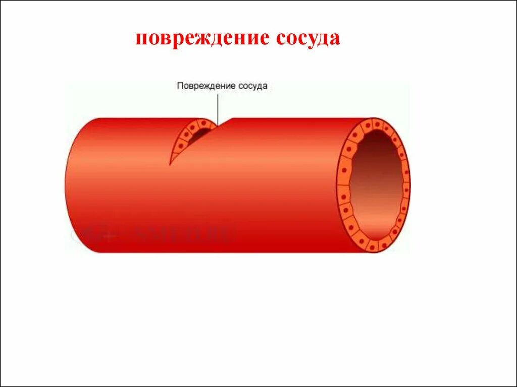 Разрыв кровеносного сосуда. Повреждение кровеносных сосудов.