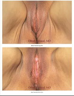 ThermiVa Before & After Photos.