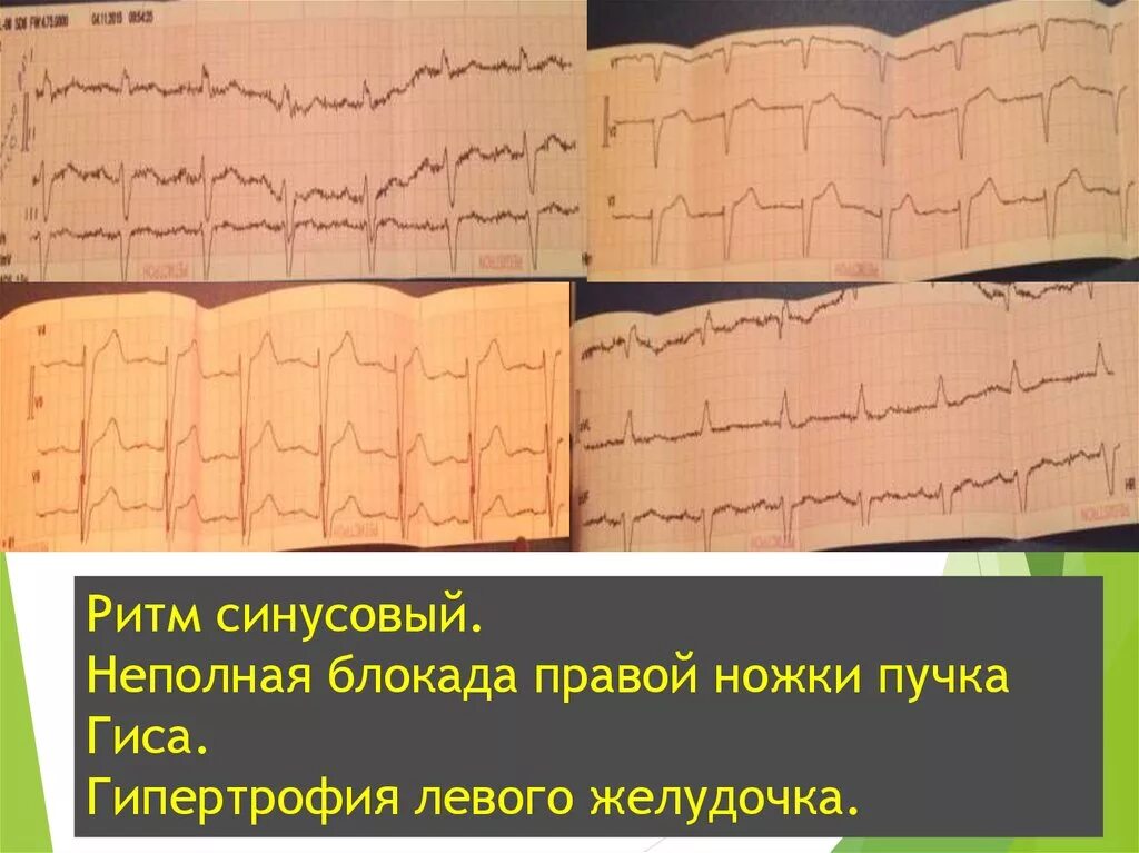 Блокада правой ножки желудочка. Пучки Гиса синусовый ритм. Синусовый ритм неполная блокада правой ножки пучка Гиса. Неполная блокада левого желудочка. Блокада левого желудочка пучка Гиса.