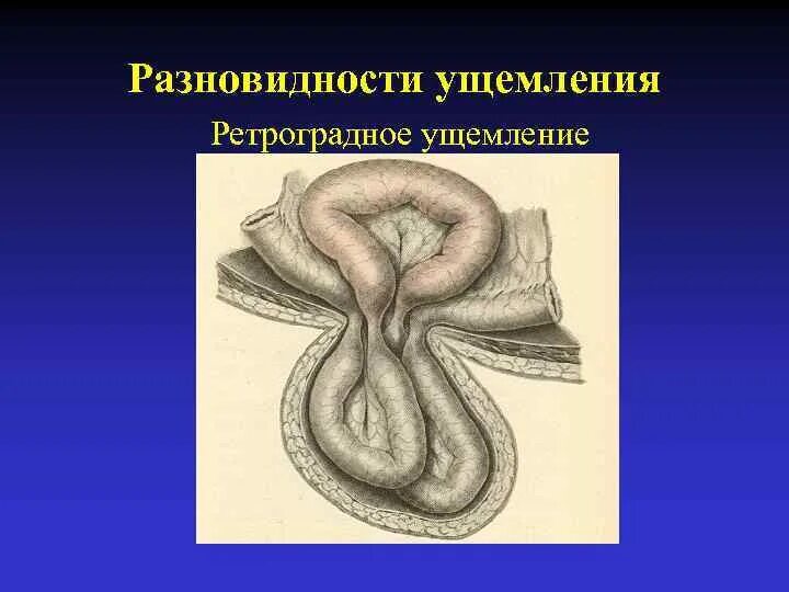 Ретроградное w образное ущемление. Пристеночное ущемление грыжи. Ретроградное ущемление грыжи. Ретроградный Рихтеровское ущемление грыжи.