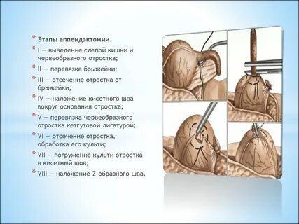 Этапы аппендэктомии