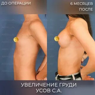 Фото после операции увеличения груди имплантами.