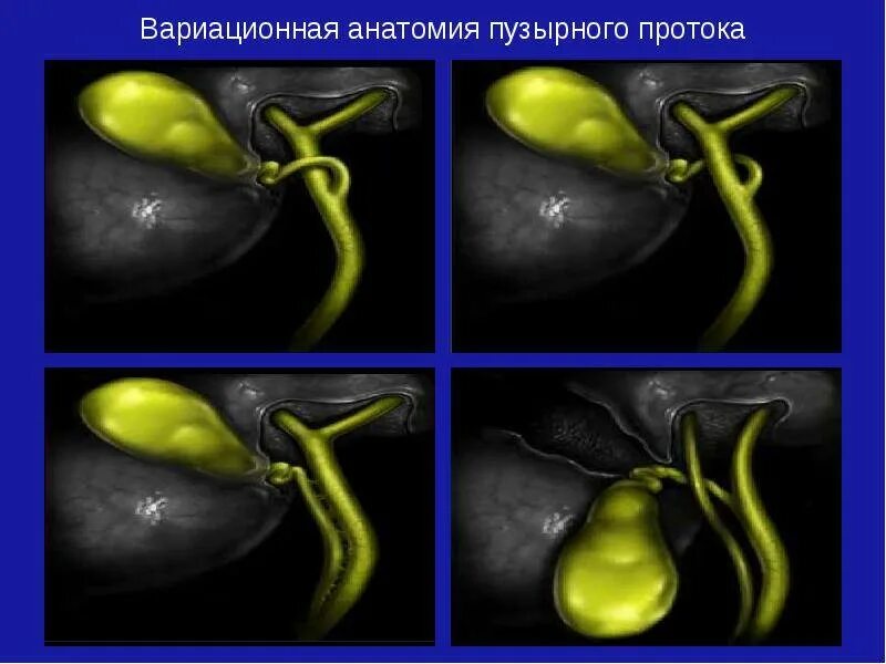 Изгиб шейки желчного. Мукоцеле желчного пузыря. Холецистэктомия желчного пузыря. Проток желчного пузыря камень.