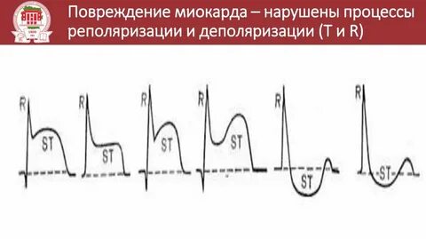 Экг нарушение процессов реполяризации диффузного характера