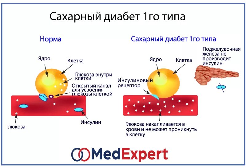 Для сахарного диабета 1 типа характерны. Сахарный диабет 1 типа характеризуется. Клиника сахарного диабета 1 типа. Сахарный диабет 1 го. Типы сахарного диабета 1 типа.