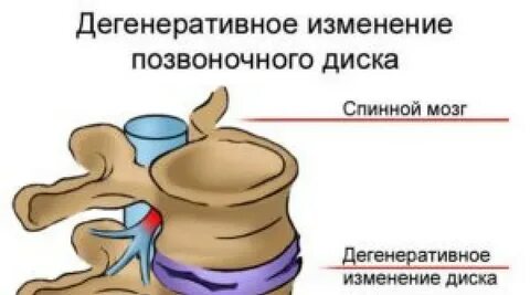 Грыжа 10
