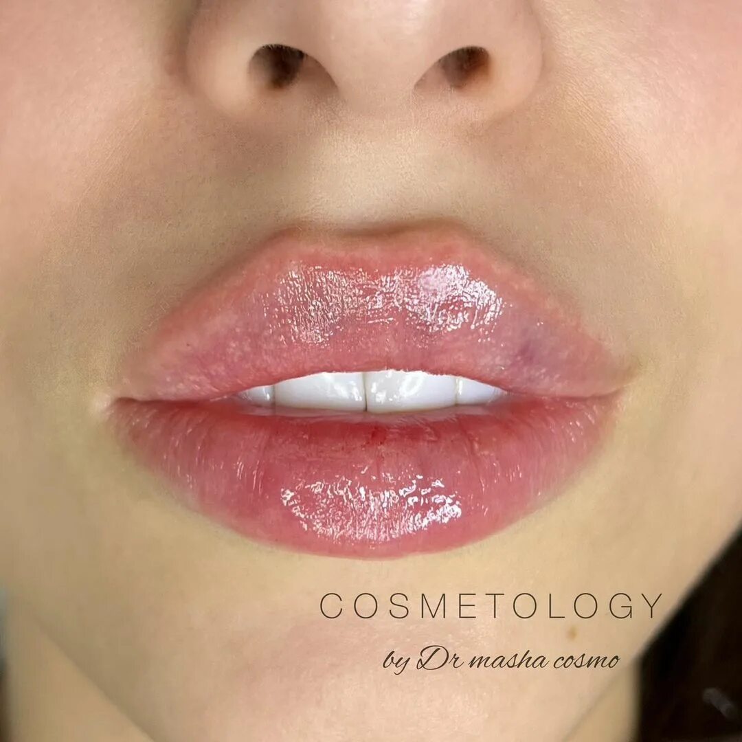 5 мл. контуринг губ гиалуроновой кислотой. накачивание губ гиалуроновой кислотой 1 мл. косметолог губы спб. косметолог губы спб.