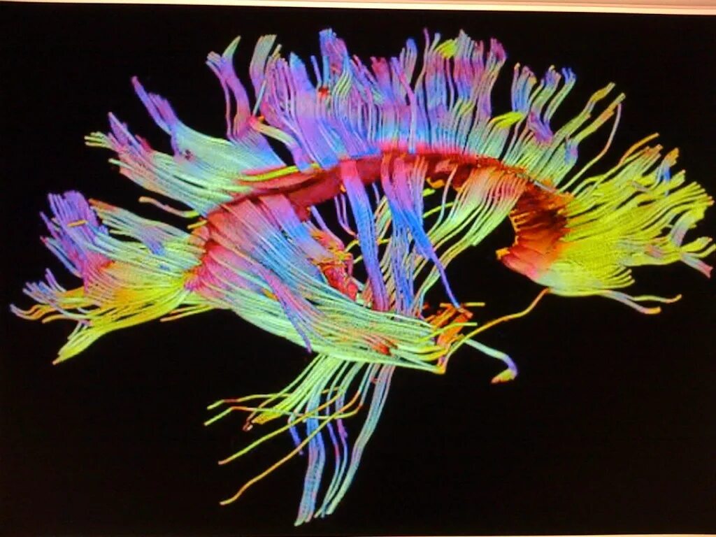 Diffusion tensor. Diffusion tensor imaging (dti). трактография головного мозга. dti mri. human connectome project.