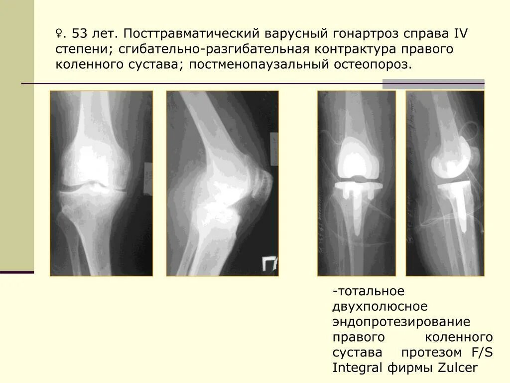 Посттравматический контрактура сустава