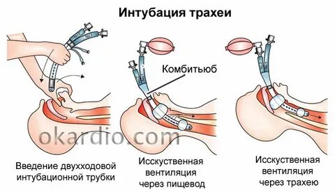 Интубация трахеи дети