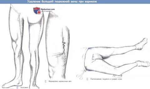 Разрез ноги