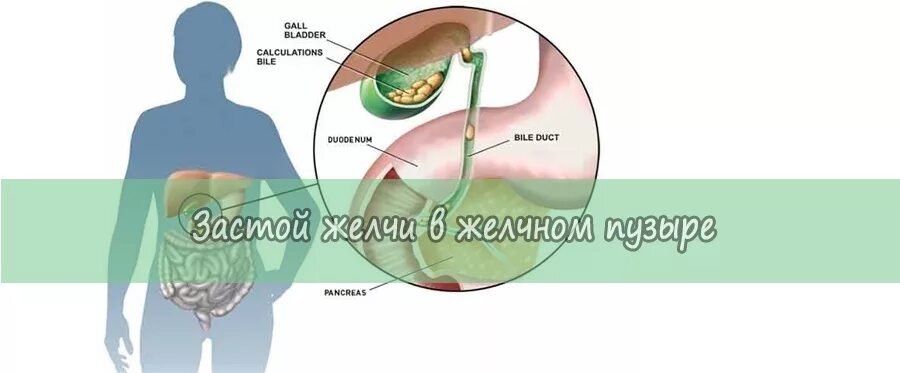 Застой желчи в желчном пузыре. Застойный желчный пузырь. Застойные явления в желчном пузыре.