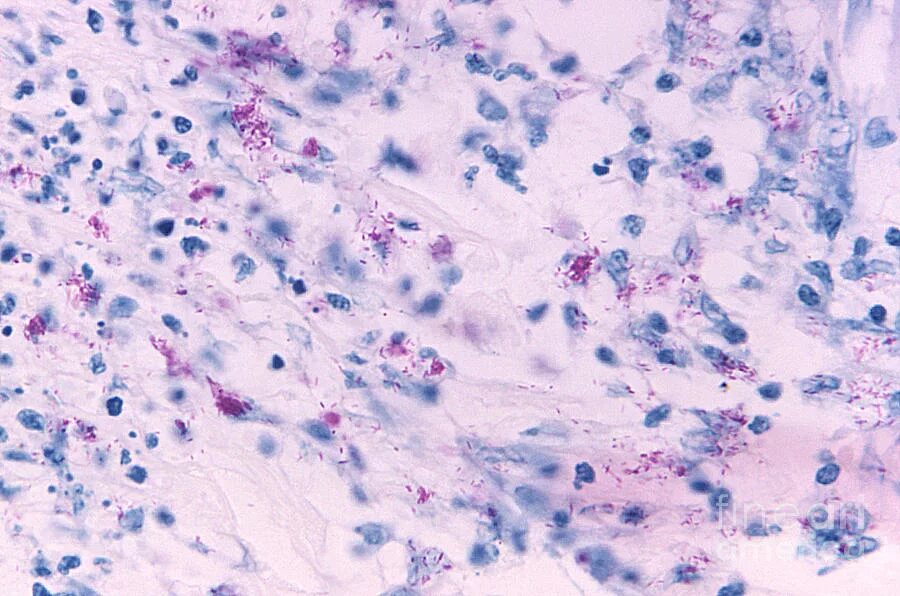 Род туберкулеза. Микобактерии лепры микроскопия. Лепра возбудитель Mycobacterium leprae. Mycobacterium leprae микроскопия. Микобактерии лепры микробиология.