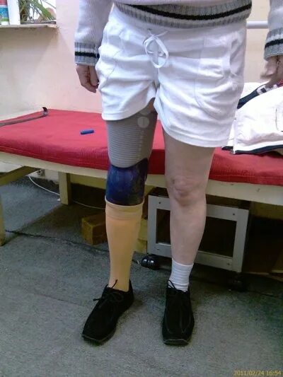 Протез голени хармони. Гильза марло протеза бедра. Кустарный протез голени. Приспособления для больных с ампутацией конечностей. Протезирование культи.