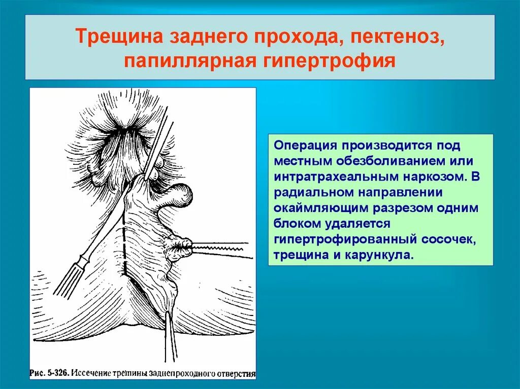 Геморройный узел наружный. Геморрой и трещины заднего.