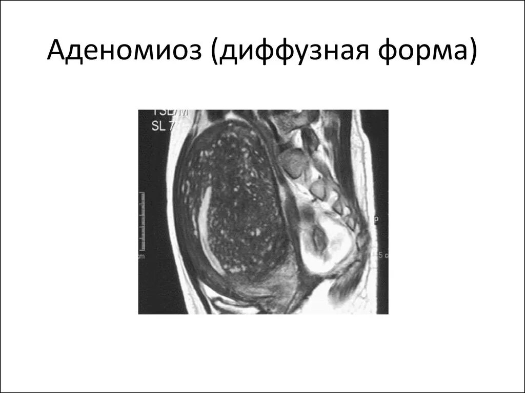 Эндометриома матки мрт. Ретроцервикальный эндометриоз мрт. Диффузно узловая форма