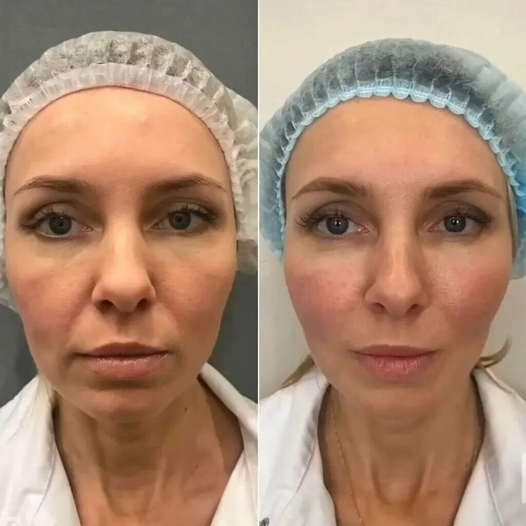 безоперационный лифтинг ultherapy. смас лифтинг альтера. смас лифтинг до и после. альтера эффекты. смас альтера.